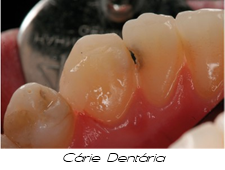 Cárie dentária