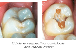 Cárie dentária