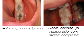 Restauração dentária