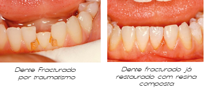 Dente fraturado e restaurado
