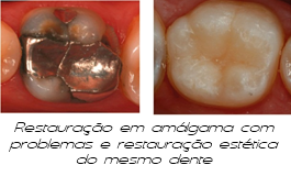 Restauração estética