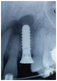 Implantes