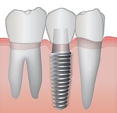 Implantes