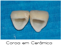 Prótese Fixa