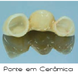 Prótese Fixa
